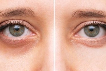 الهالات السوداء تحت العين: أسبابها وطرق علاجها